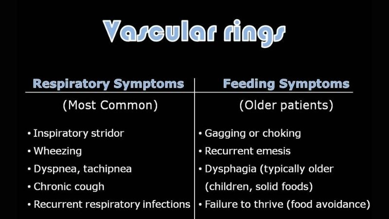 Vascular ring and stridor breathing difficulties in infants