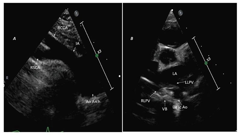 Vascular ring in adults late diagnosis and management
