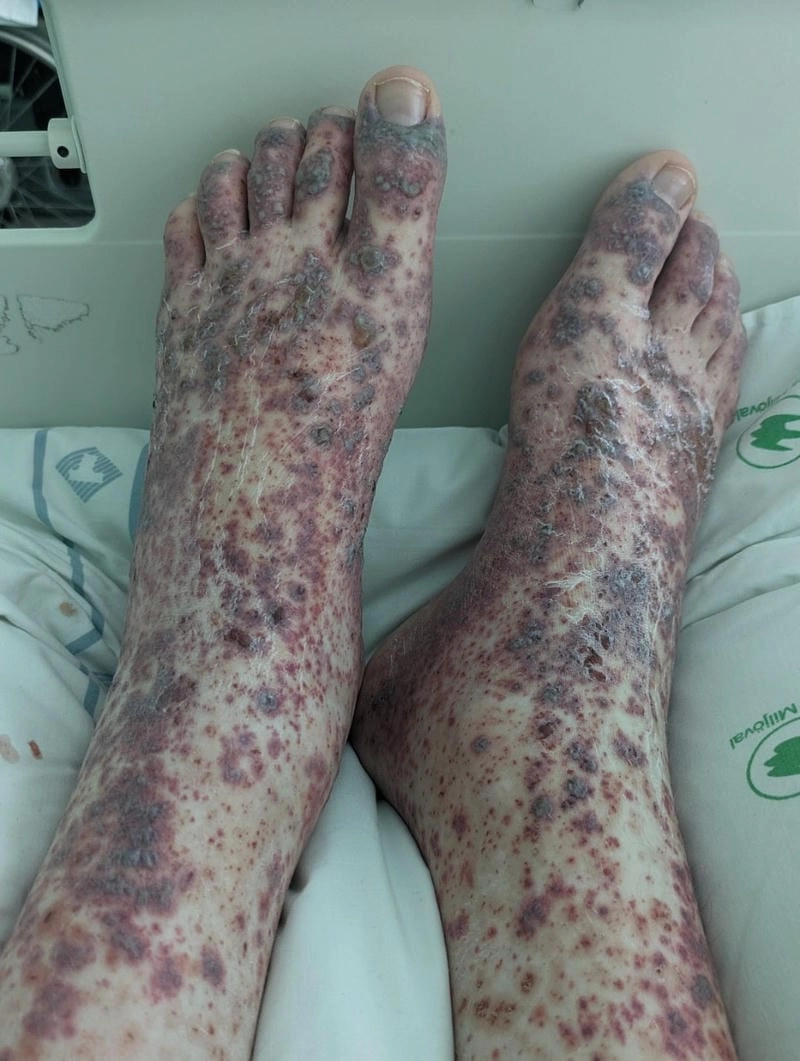 Chart of available vasculitis treatment options