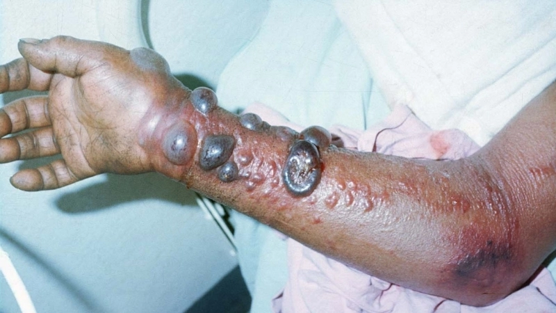 Venezuelan Hemorrhagic Fever a severe hemorrhagic fever