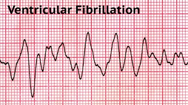Cardiac arrest is a sudden stop of effective heart function