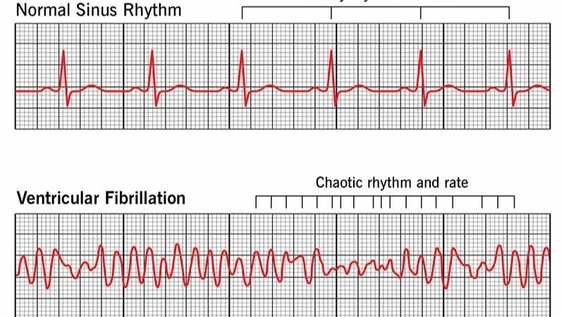 VFib causes chaotic heartbeats that require urgent treatment