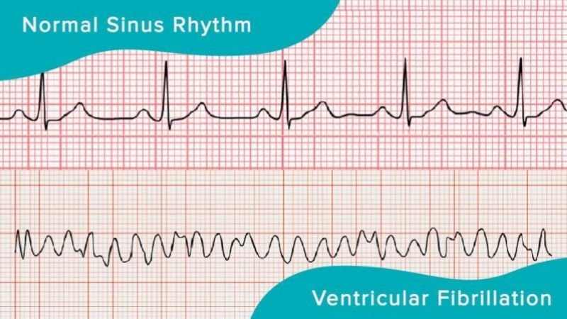 Sudden cardiac death occurs from severe heart rhythm disturbances