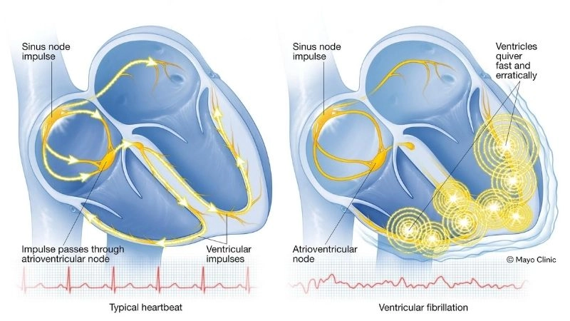Arrhythmia involves irregular or abnormal heartbeats