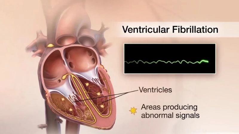 Cardiac ablation treats abnormal heart rhythm sources