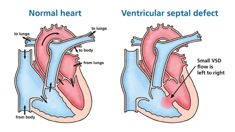 Ventricular septal defect in adults risks of late detection