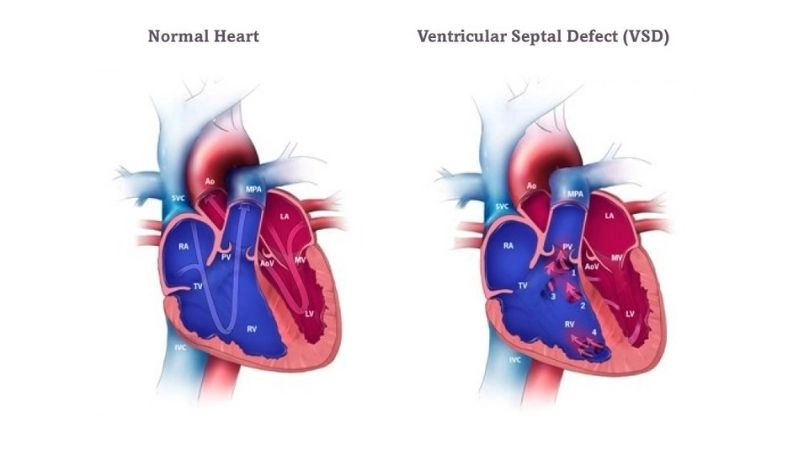 Ventricular septal defect in babies common congenital condition