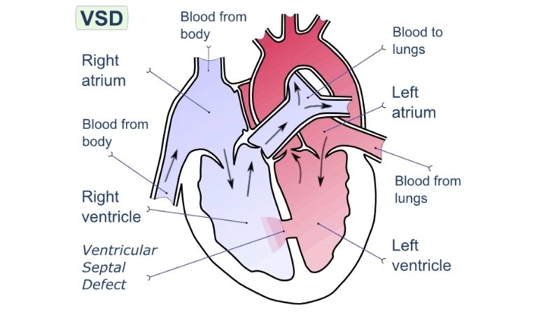 Ventricular septal defect surgery repairing hole in the septum