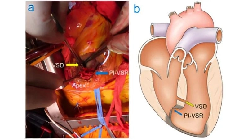 Ventricular septal defect closure sealing abnormal opening