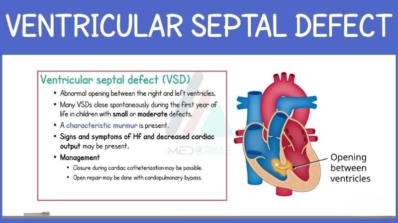 Ventricular septal defect heart murmur common clinical finding