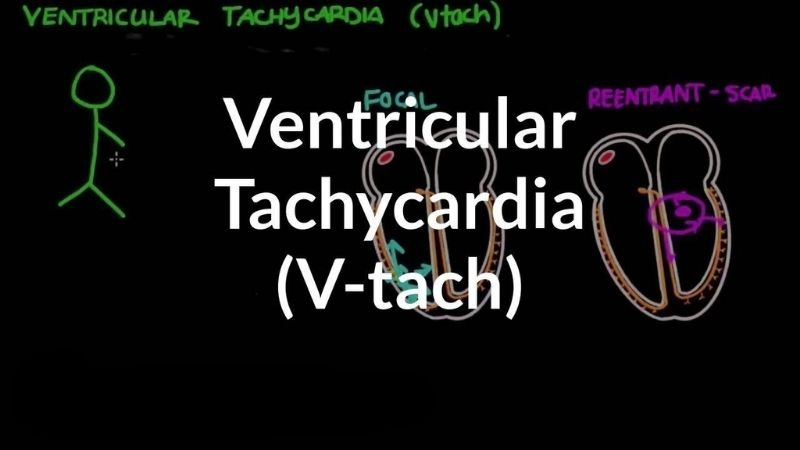 Ventricular tachycardia treatment restores safe heart rhythm quickly