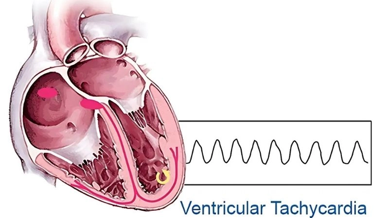 Ventricular tachycardia symptoms include palpitations and dizziness