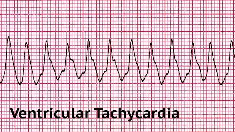 Ventricular tachycardia ECG shows rapid wide QRS complexes