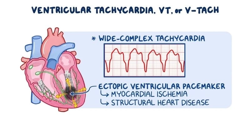 Catheter ablation for VT provides long term rhythm control