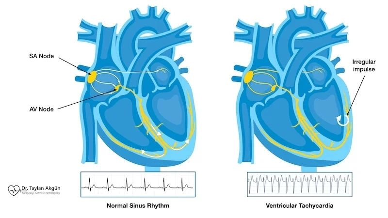 Causes of ventricular tachycardia include heart disease and imbalances