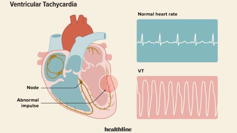 Implantable cardioverter-defibrillator ICD for VT prevents cardiac events
