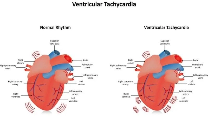 Ventricular tachycardia in children needs specialized care