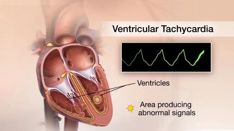 Sudden cardiac death SCD and VT needs urgent prevention