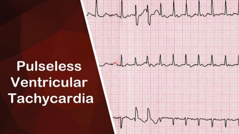 VT storm involves repeated rapid heart episodes