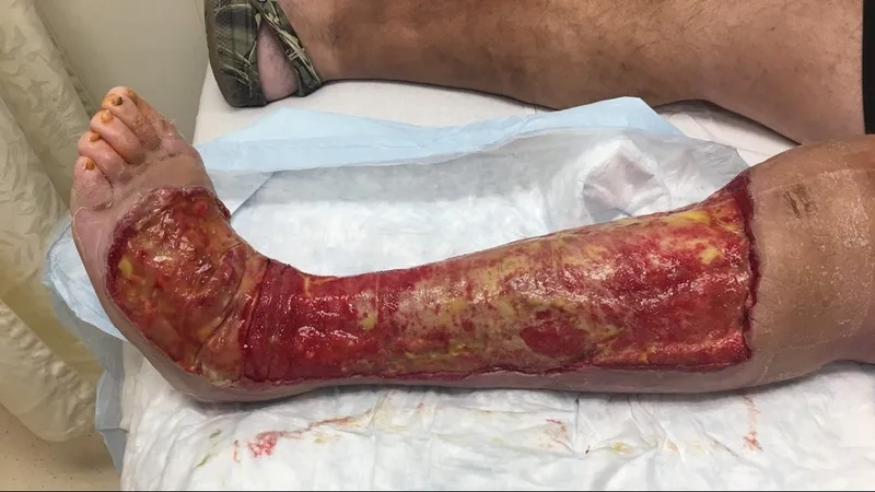 The serious health risks of Vibrio vulnificus