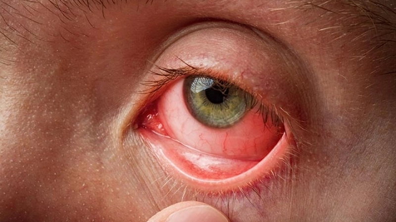 Viral Conjunctivitis Pink Eye symptoms guide