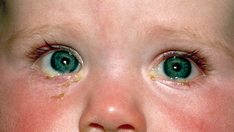 Viral Conjunctivitis Pink Eye adenovirus cause