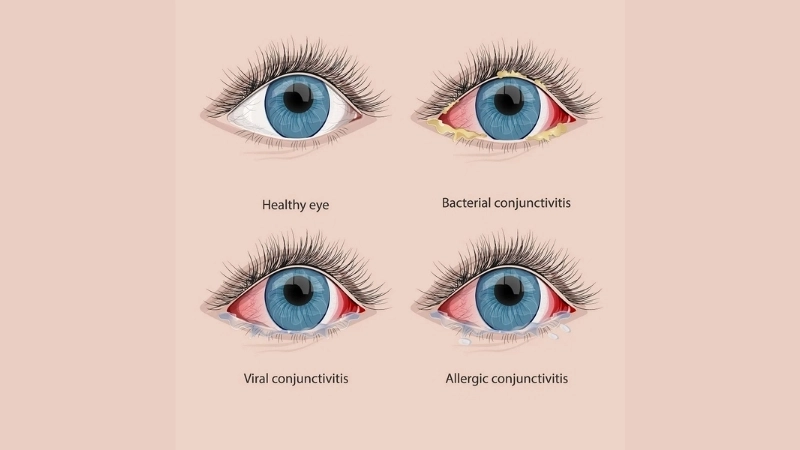 Viral Conjunctivitis Pink Eye causes explained