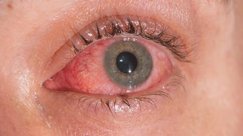 Viral Conjunctivitis Pink Eye prevention advice