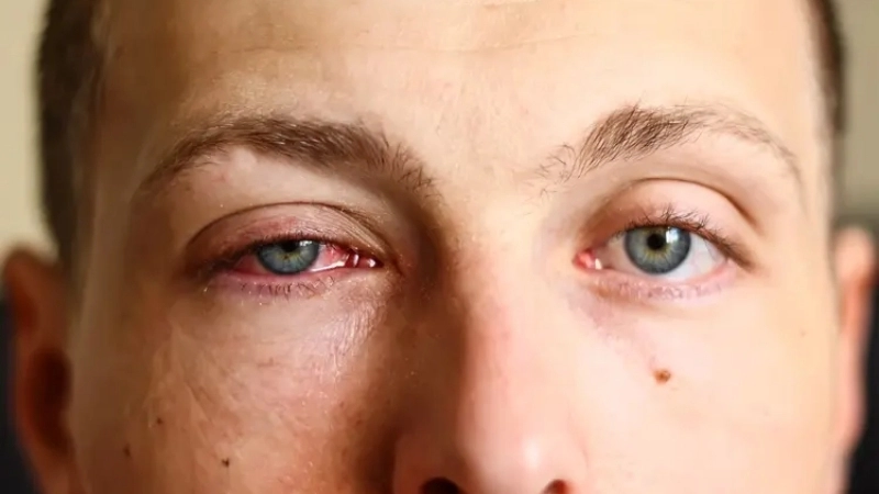 Viral Conjunctivitis Pink Eye remedies shared