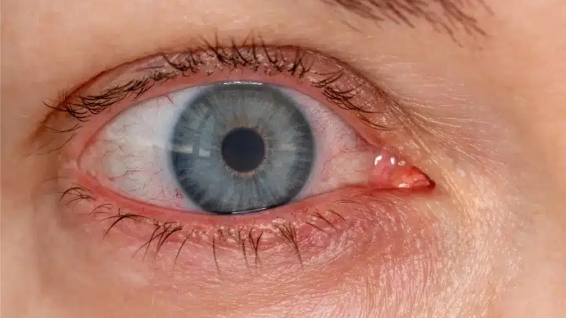 Viral Conjunctivitis Pink Eye vs allergic conjunctivitis