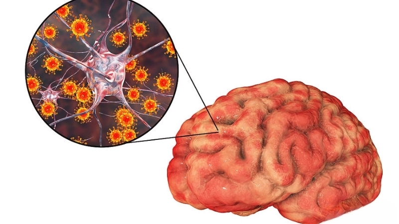 Encephalitis diagnosis requires imaging and lab tests