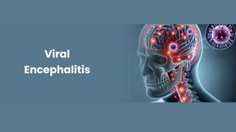 Rabies encephalitis is rare but highly fatal