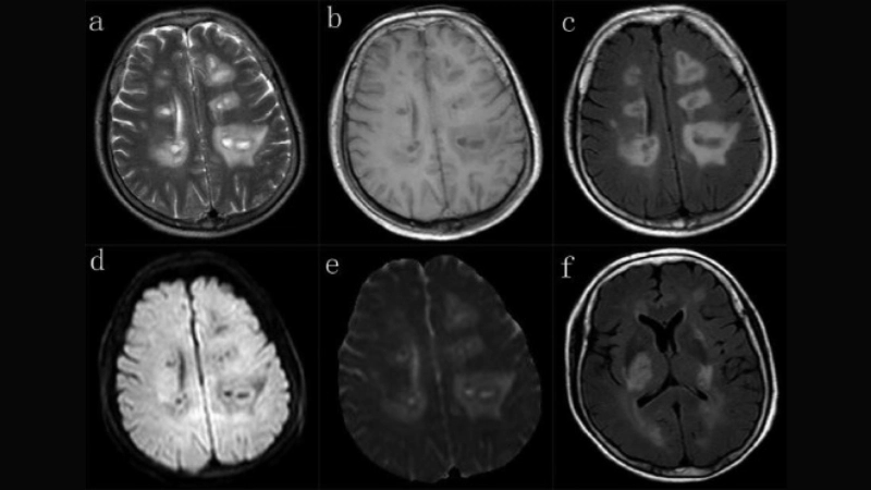 Viral encephalitis treatment depends on infection type