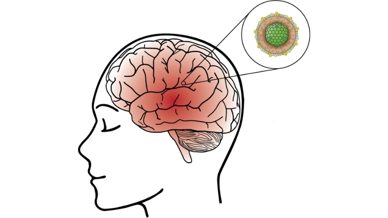 Meningoencephalitis combines meningitis and encephalitis