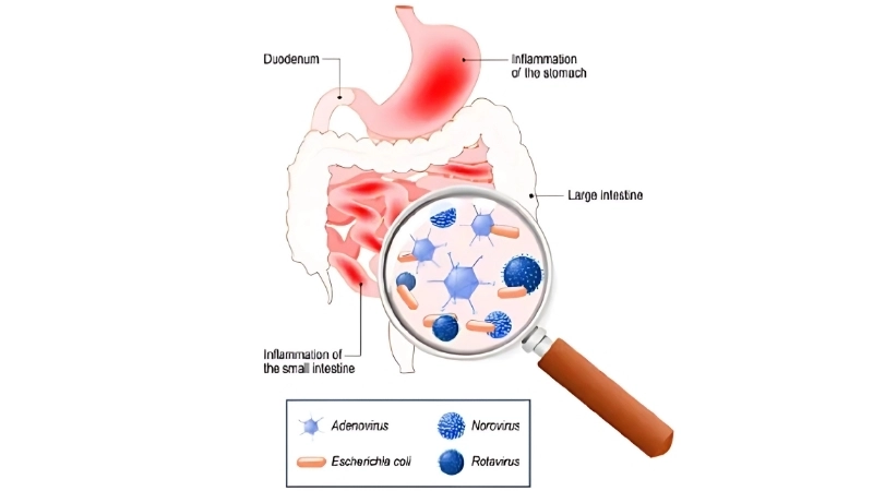 Viral Gastroenteritis symptoms stomach flu