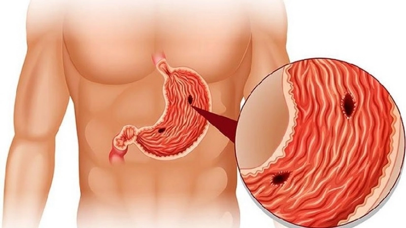 Viral Gastroenteritis vomiting stomach flu