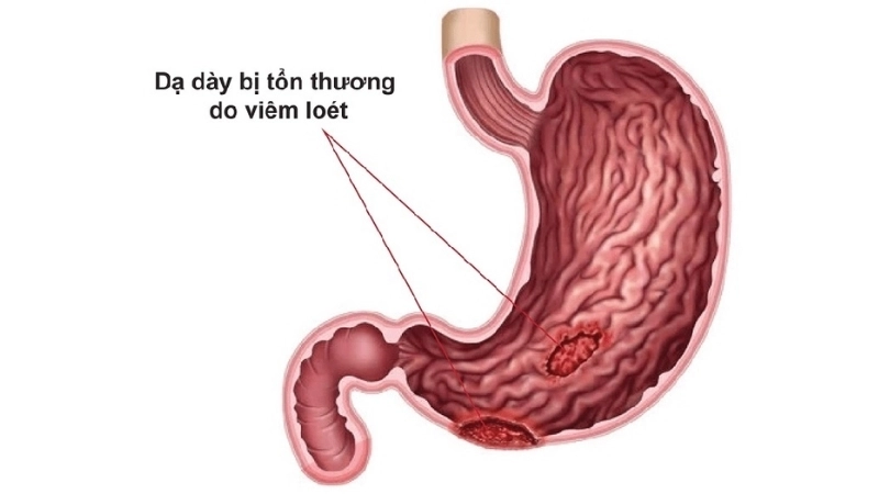 Viral Gastroenteritis stomach cramps flu