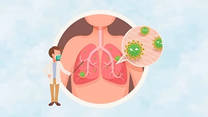 Prevent hospital acquired pneumonia in patients