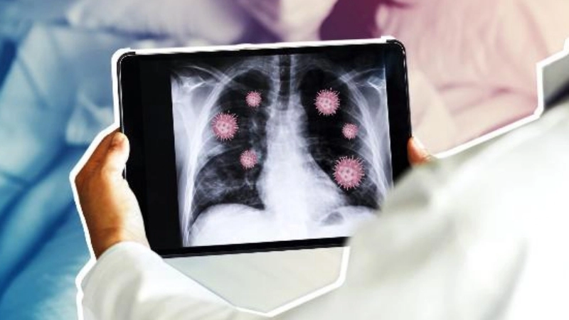 Understand main viral pneumonia causes today