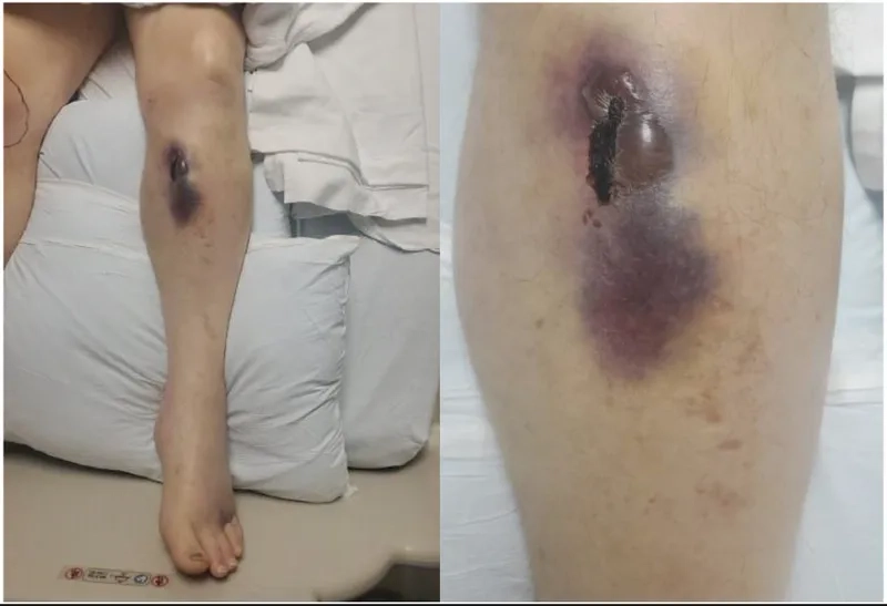 A chart comparing the types of von willebrand disease