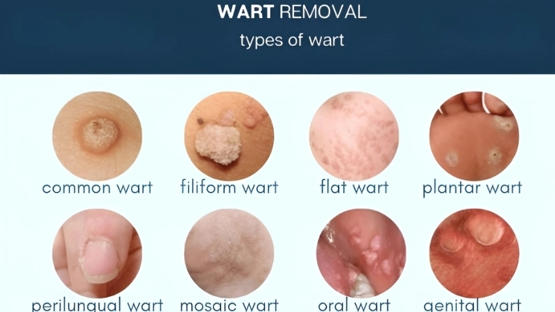 Warts common plantar genital and warts on feet