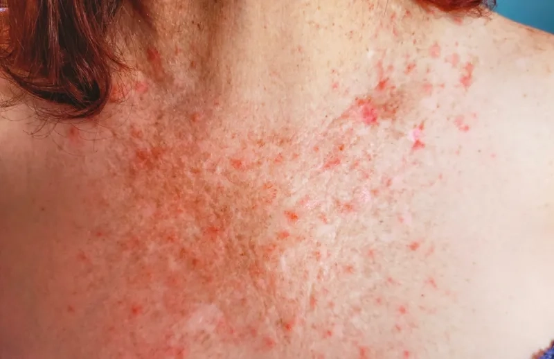 Understanding West Nile Virus long term effects