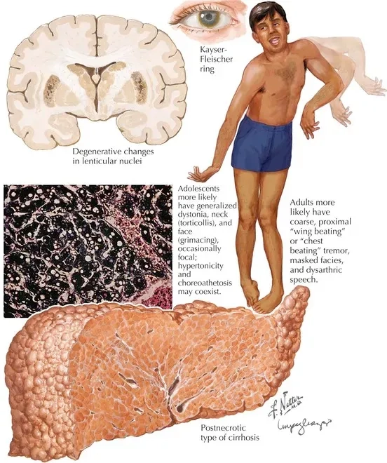 Recognizing common Wilson's disease symptoms