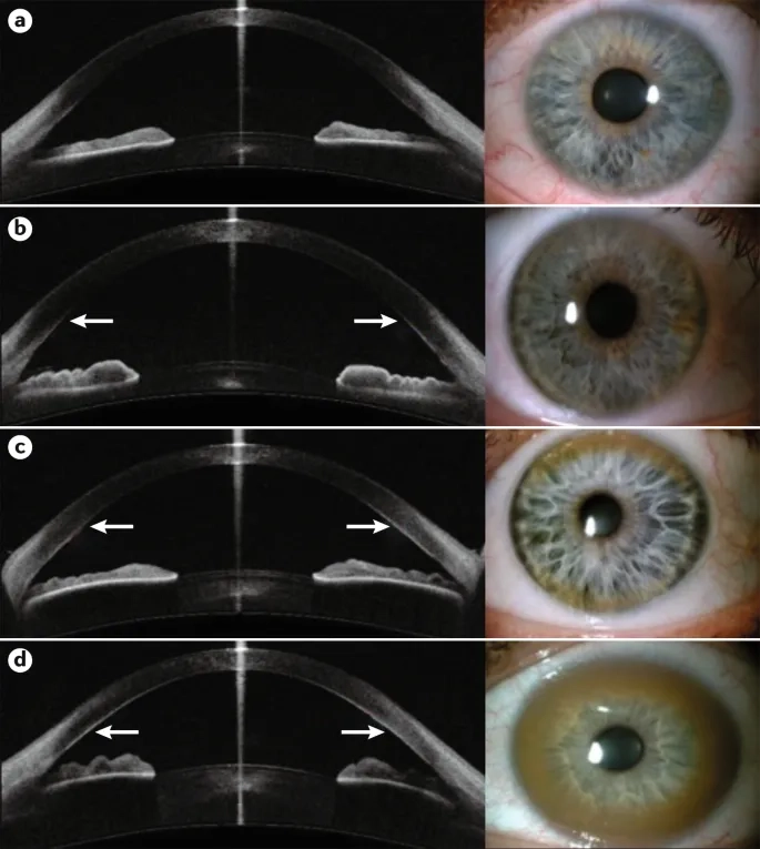 Patient receiving Wilson's disease treatment