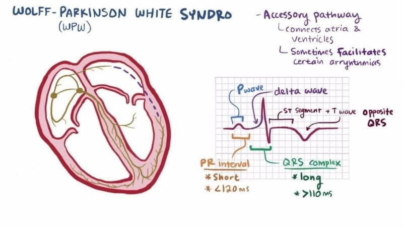Wolff Parkinson White Syndrome Symptoms reveal fast heartbeat