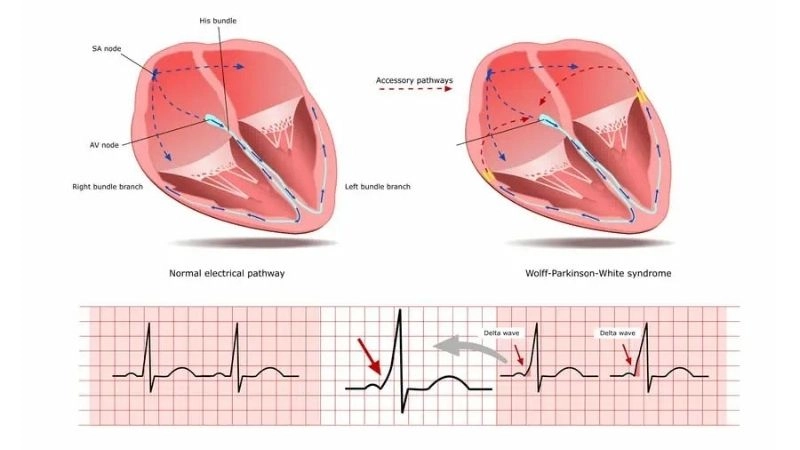 WPW Syndrome Treatment helps control abnormal rhythm