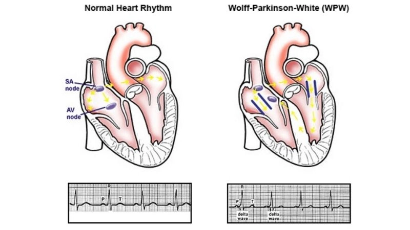 WPW Syndrome Diagnosis confirms hidden heart disorder