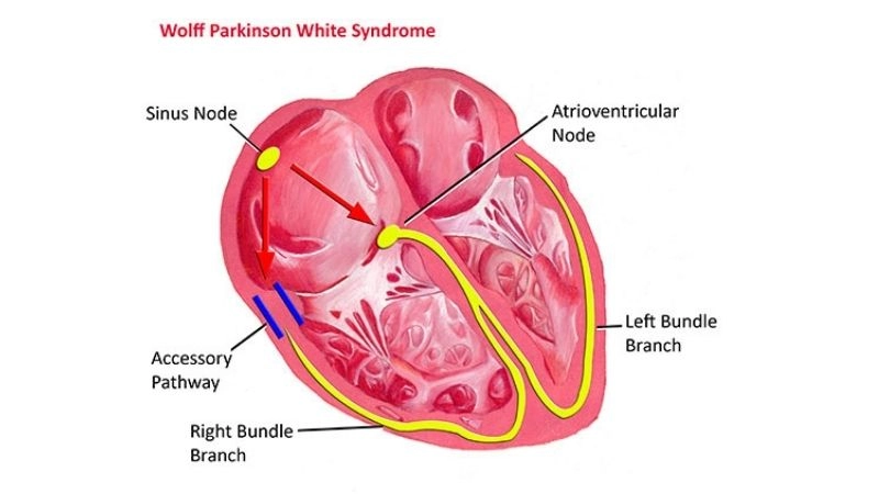 WPW Syndrome Catheter Ablation restores steady rhythm