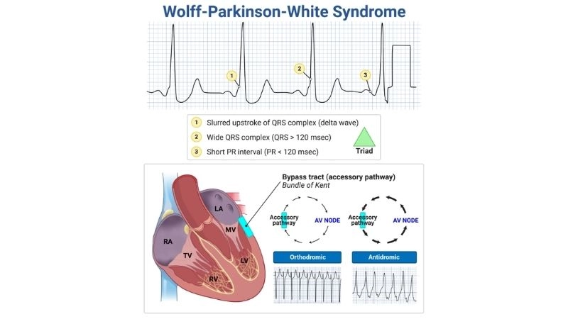Wolff Parkinson White Syndrome In Infants needs care