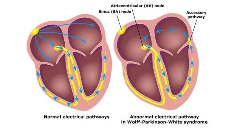 WPW And Sports raise concern for safe activity